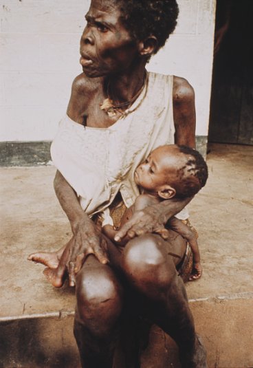 View of a starving and emaciated young child from the Biafra region being cradled on the knee of an adult woman in a camp during the civil war in Nigeria in August 1968G